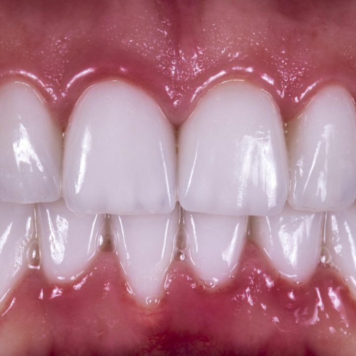 press ceramic crowns and veneers b1 color