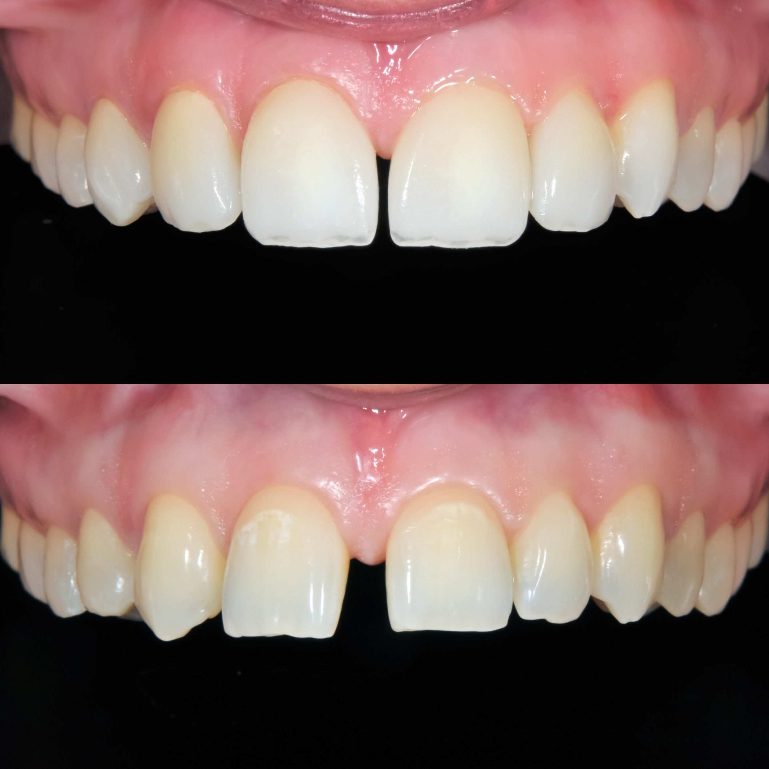 Before and after Smile design dental procedure photos . Selective soft focus.You can find more dental related images like this one here :